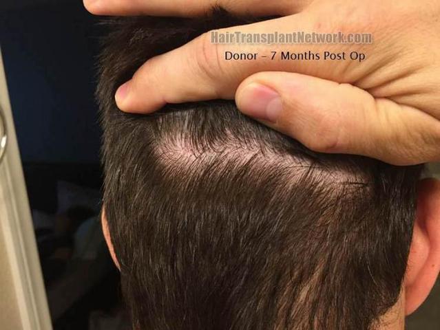 Hair restoration procedure before and after results