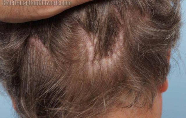 Hair replacement surgery before and after images