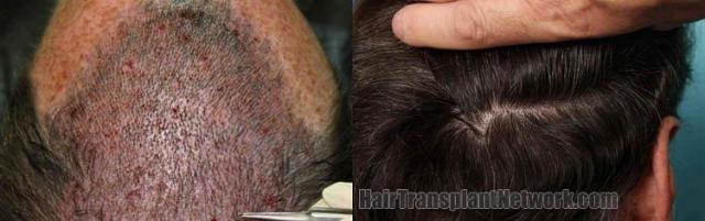 Scar / Intraoperative hair restoration photos