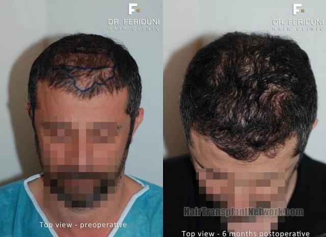 Hair restoration procedure before and after pictures