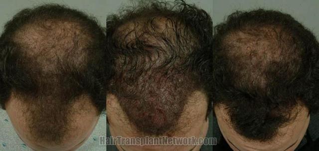 Surgical hair transplantation images before and after