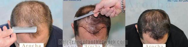 Top view - Before and after surgical hair replacement