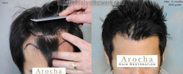 Top view before and after hair restoration results