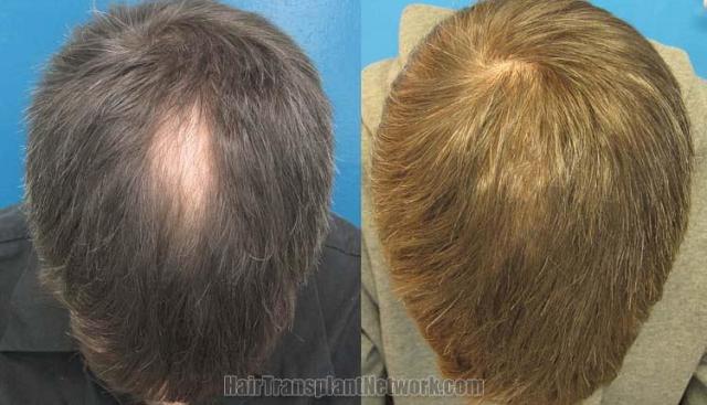 Top view before and after hair restoration results