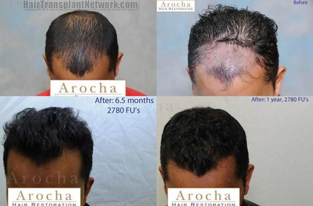 Hair transplantation surgery before and after photos