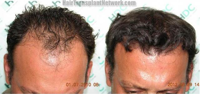 Hair transplantation surgery before and after images