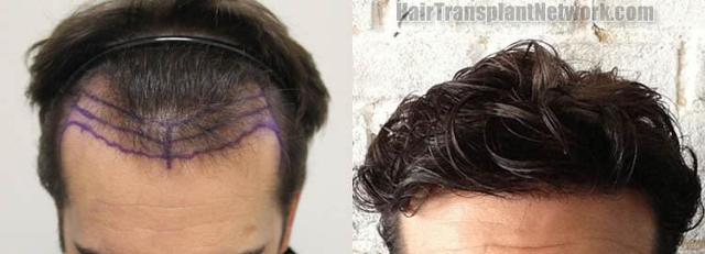 Hair restoration procedure before and after pictures