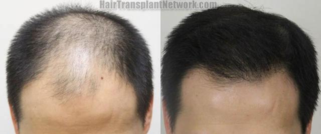 Hair transplantation surgery before and after photos