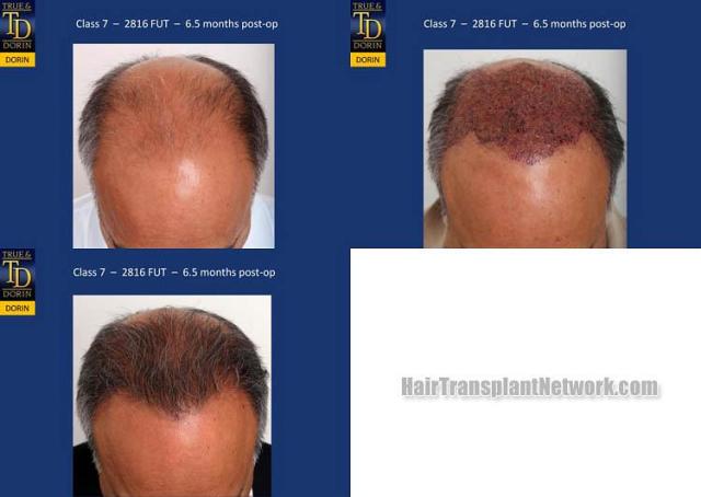 Top view - Before and after surgical hair replacement