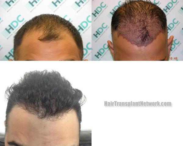 Hair transplantation surgery before and after pictures