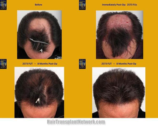 Hair transplantation surgery before and after photos