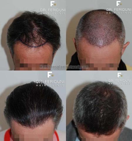 Top view before and after hair restoration results