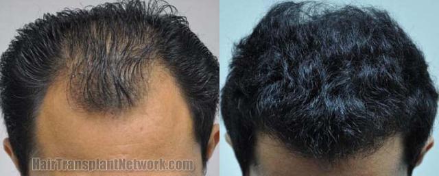 Hair restoration procedure before and after results