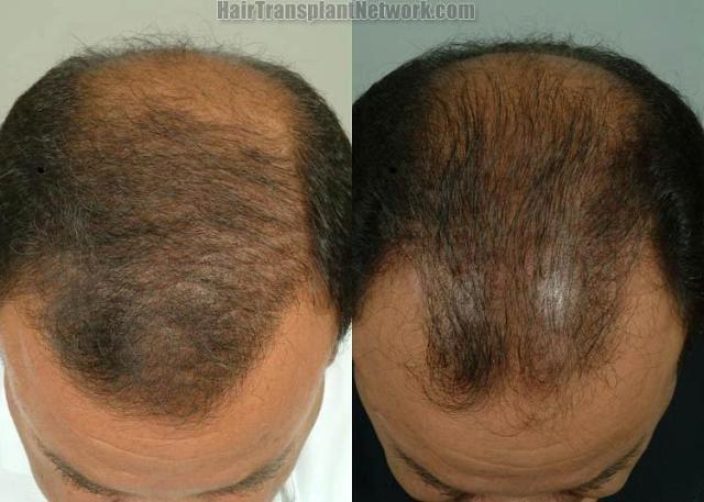 Hair transplant surgery before and after pictures