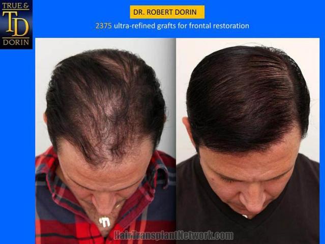 Hair transplantation surgery before and after photos