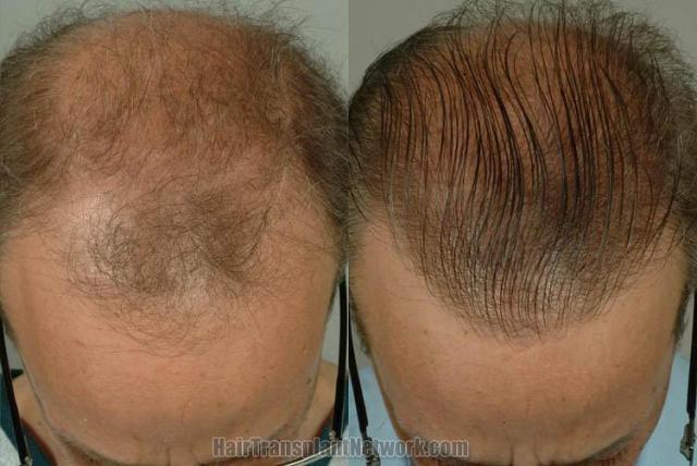 Hair transplantation surgery before and after photos