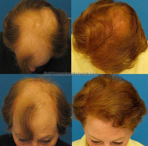 Hair transplantation surgery before and after images