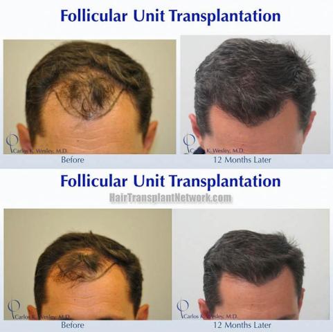 Hair transplantation surgery before and after images