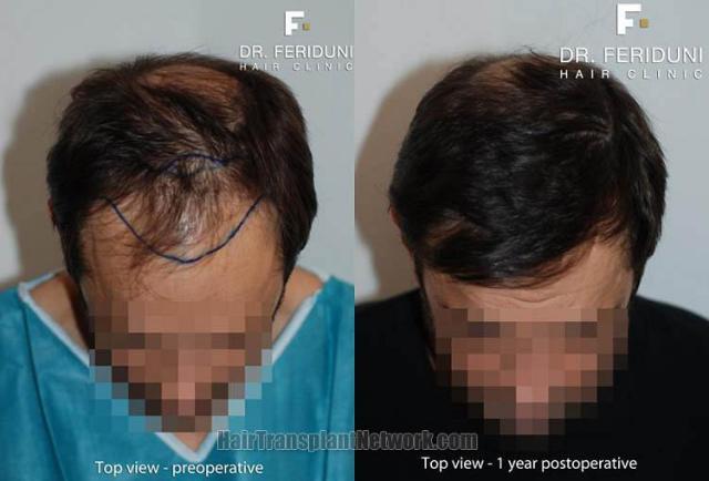 Top view - Before and after surgical hair replacement