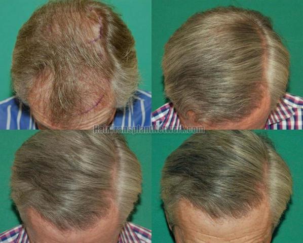 Hair restoration procedure before and after results