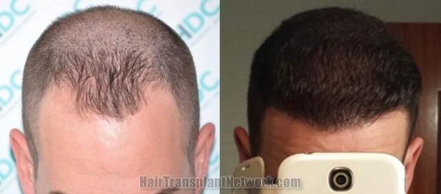 Hair restoration procedure before and after results