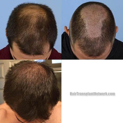 Hair restoration procedure before and after pictures