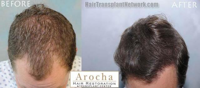 Hair transplantation surgery before and after pictures