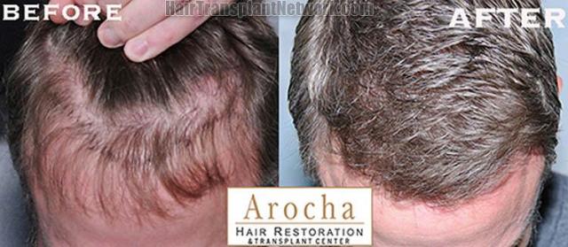 Top view before and after hair restoration results