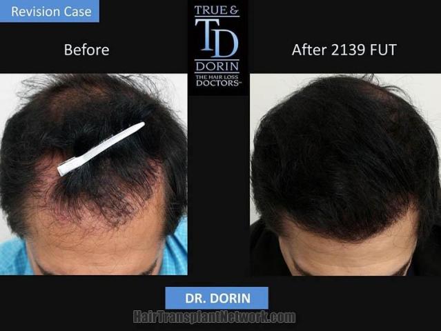 Top view before and after hair restoration results