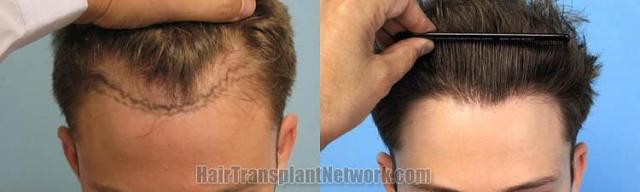 Hair restoration procedure before and after results