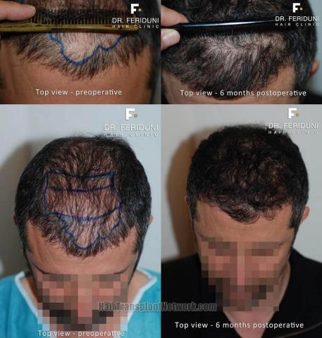 Hair restoration procedure before and after results