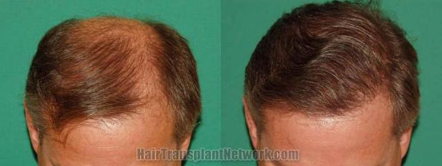 Hair restoration procedure before and after results