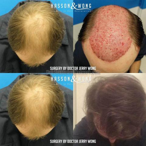 Before and after hair restoration procedure images