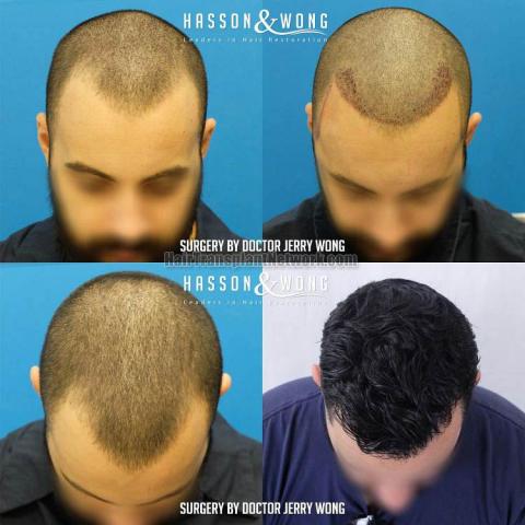 Hair transplantation surgery before and after images