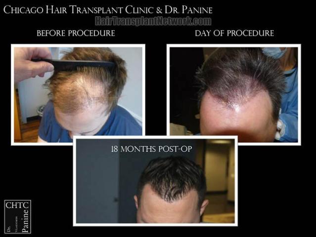 Before and after hair restoration procedure images