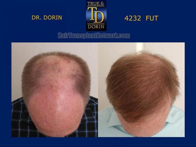 Top view - Before and after hair restoration procedure