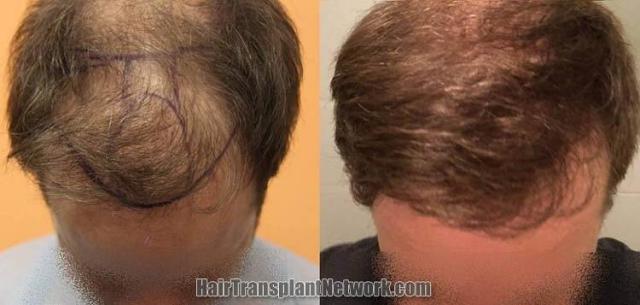 Hair transplantation surgery before and after images