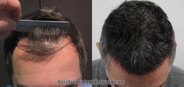 Hair restoration procedure before and after results