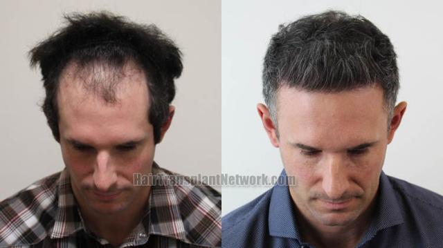 Hair transplantation surgery before and after images