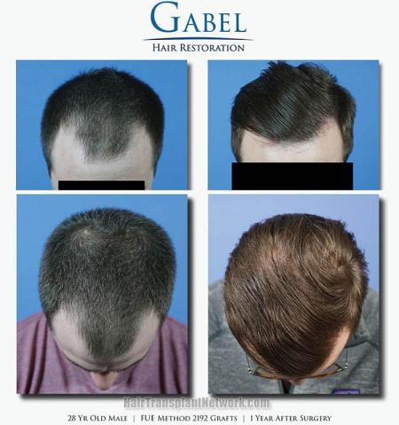 Hair transplantation surgery before and after images