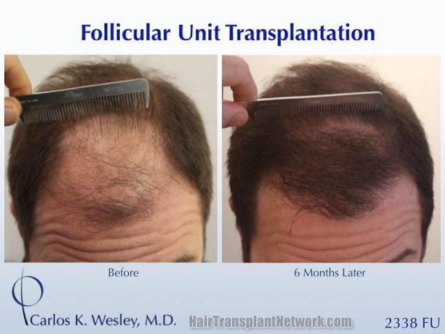 Hair restoration procedure before and after results