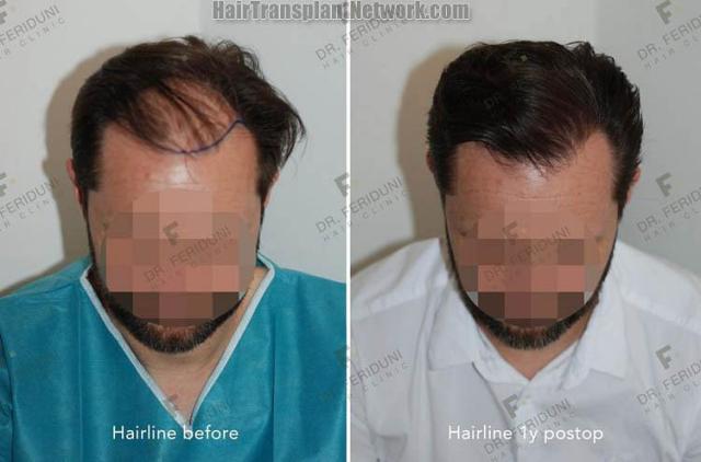 Hair transplantation surgery before and after images