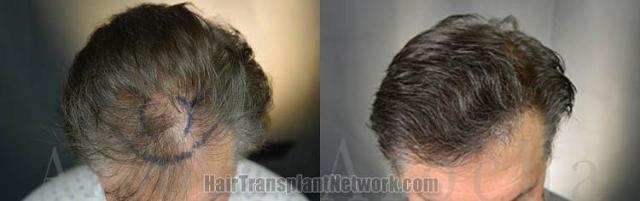 Hair transplantation surgery before and after images