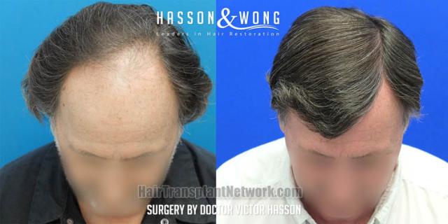 Hair transplantation surgery before and after images