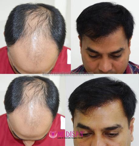 Hair transplantation surgery before and after images