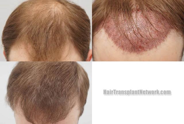 Hair restoration procedure before and after results