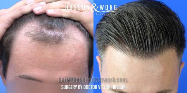 Before and after hair restoration procedure images