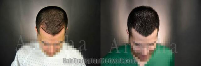 Hair restoration procedure before and after results