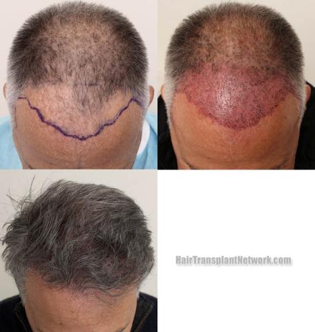 Hair transplantation surgery before and after images