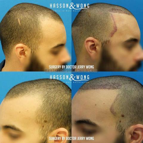 Hair restoration procedure before and after result images